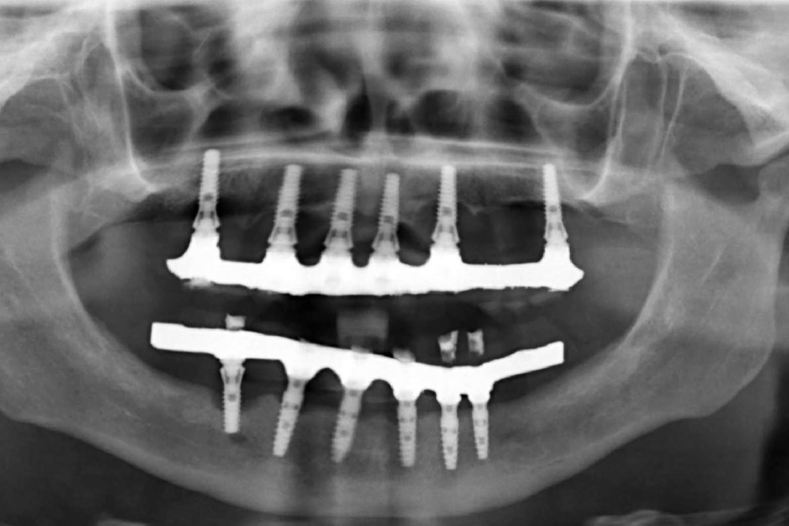 Toda la información necesaria sobre los implantes dentales de la Clínica Calvo de Mora
