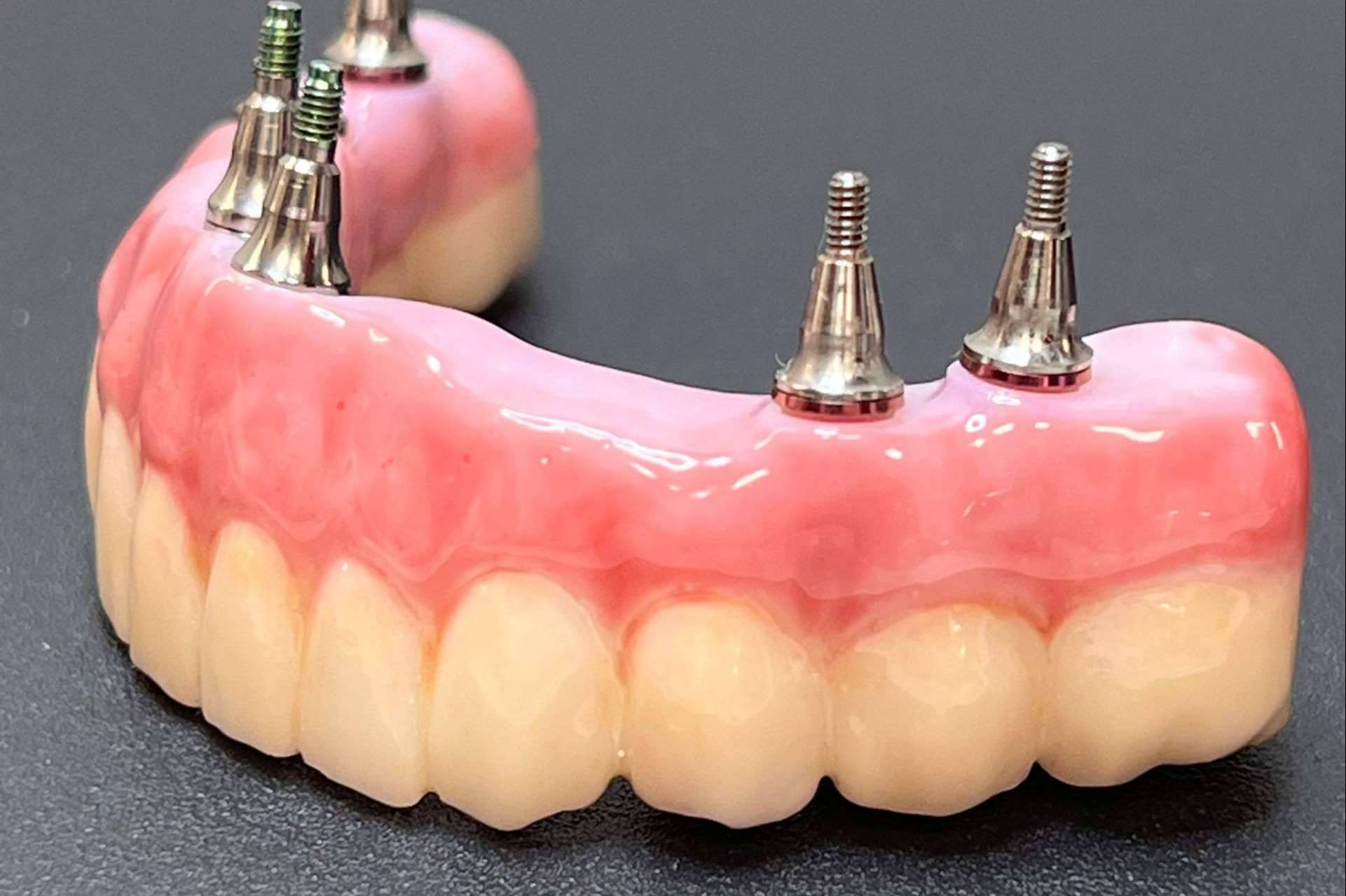 Dentinova cuenta con la tecnología y el equipo profesional para realizar extracciones e implantes dentales en la misma consulta