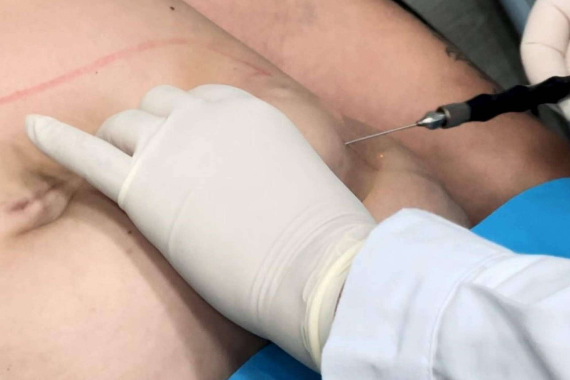 Innovación estética en 360Clinics con Lipo Láserfit Medical, el futuro de los tratamientos corporales sin cirugía
