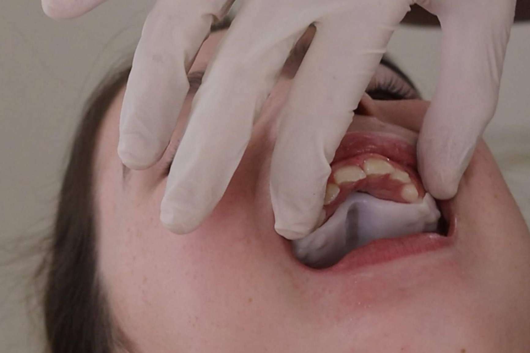 Smart Aligner Services, Pioneer in Europe’s First Event on Invisalign Palatal Expander