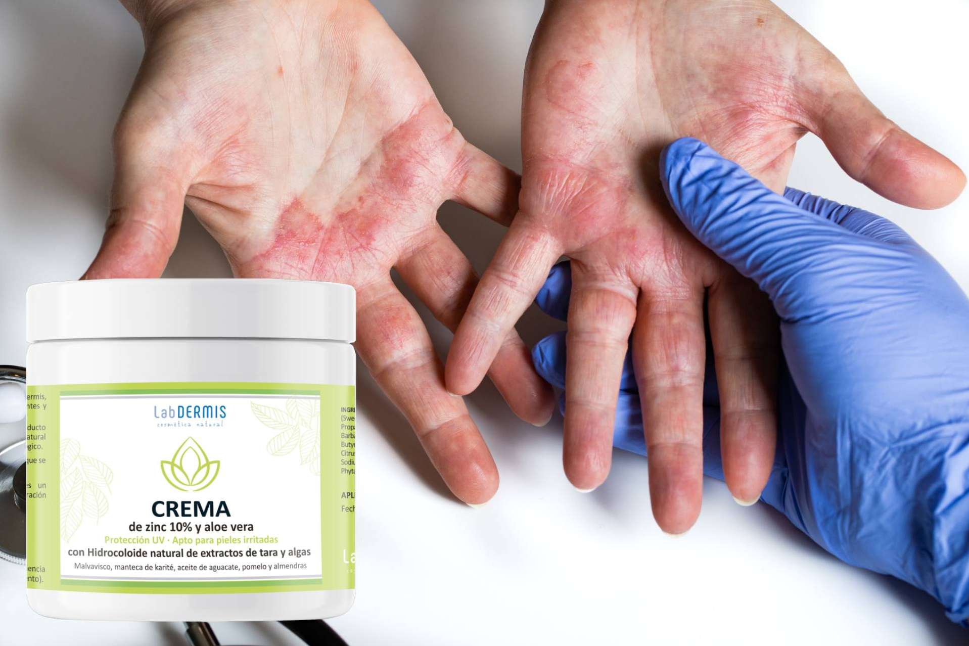 Dermatitis atópica y cuidados específicos de la piel aconsejados por el laboratorio LabDERMIS