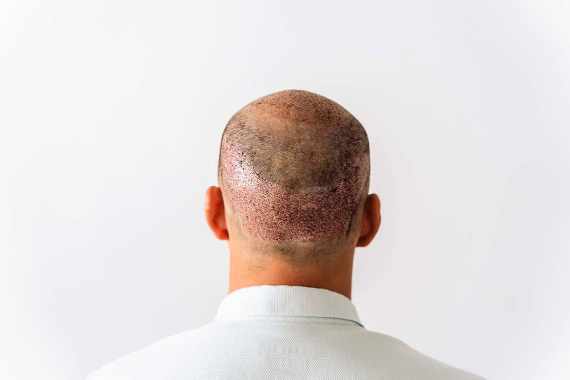 Trasplante capilar con efecto natural en 6 meses; la fórmula exclusiva del Dr. Aníbal Mora marca la diferencia