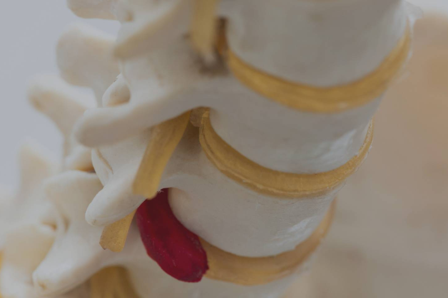 La fisioterapia avanzada, la nueva aliada para evitar cirugías en hernias discales
