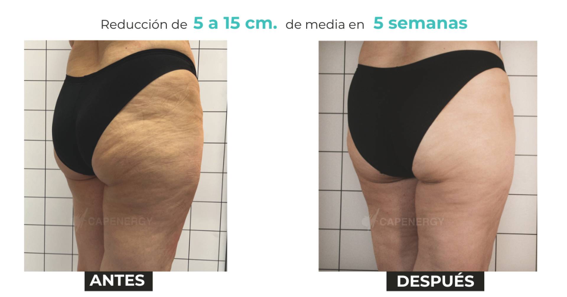 Radiofrecuencia multicanal y enzimas lipolíticas logran 14,8 cm de reducción