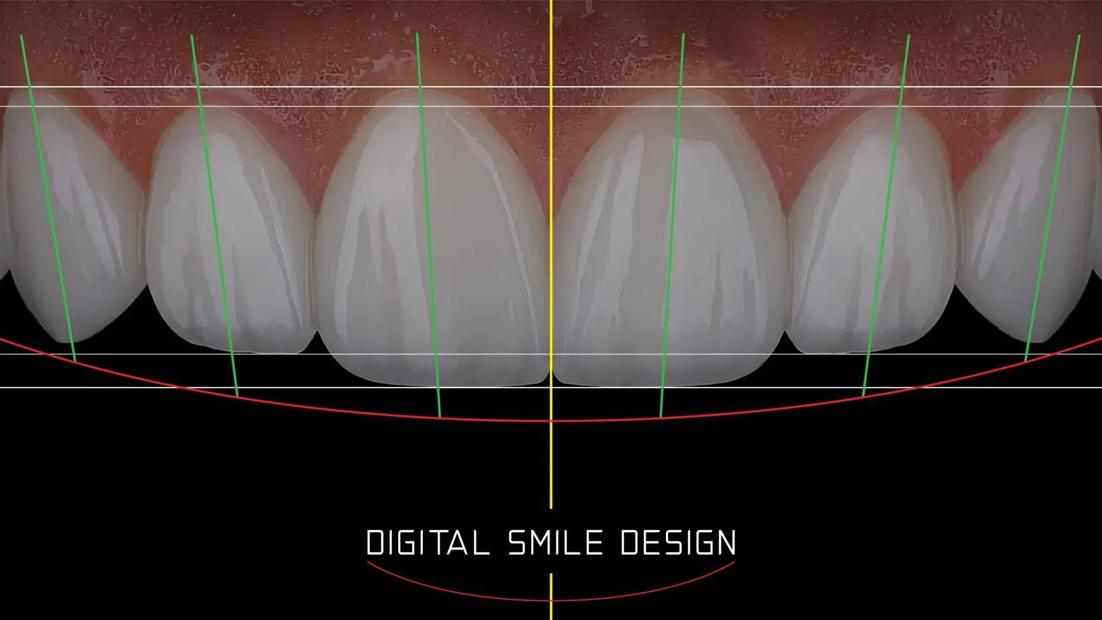 Cómo el Instituto Smile Design by Fernando Soria logra una sonrisa perfecta en Madrid mediante carillas de porcelana inmediatas